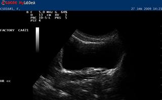 Transverse ultrasound scan of the bladder base at rest